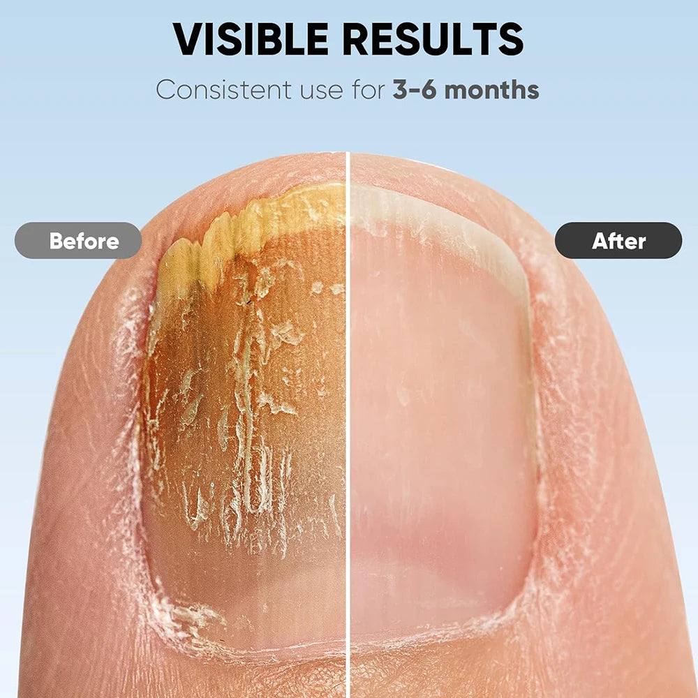 Nail Care Device Nails Fungal Treatment Repairing Thickened Gray Nails Relieve Ingrown Nail Cleaning Tools Foot Health Care