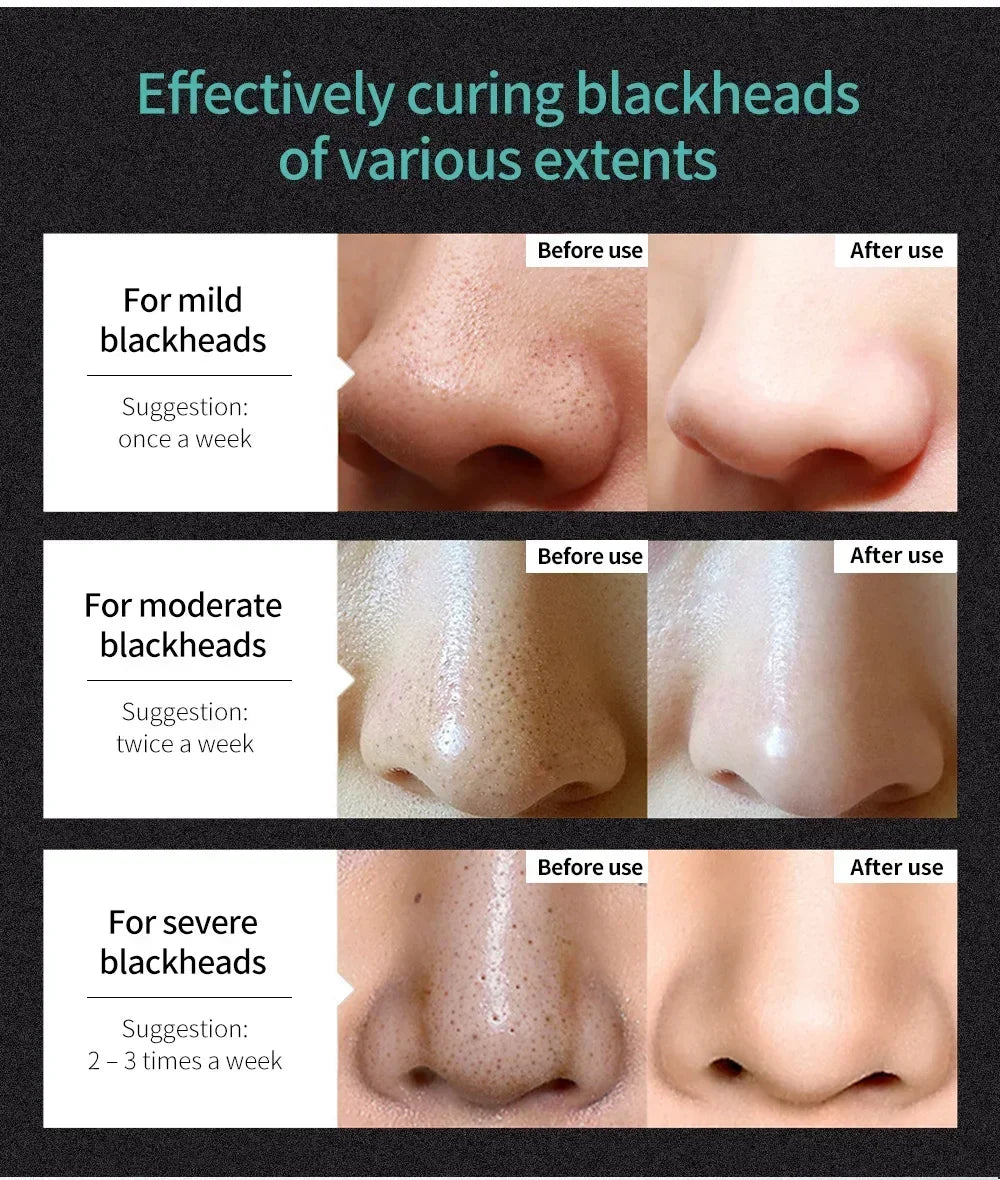 LANBENA Remove Blackhead Mask Shrinking Pore Deep Cleaning Mask Improve Rough Skin Acne Treatment Skin Brighteing Care Beauty
