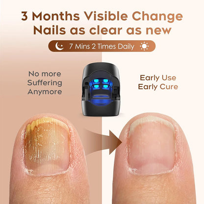 Nail Care Device Nails Fungal Treatment Repairing Thickened Gray Nails Relieve Ingrown Nail Cleaning Tools Foot Health Care