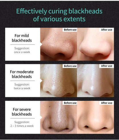 LANBENA Remove Blackhead Mask Shrinking Pore Deep Cleaning Mask Improve Rough Skin Acne Treatment Skin Brighteing Care Beauty